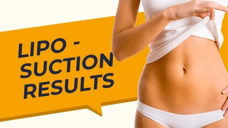 Liposuction